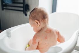 <b>AZS u dzieci i dorosłych – jak pielęgnować skórę atopową?</b>