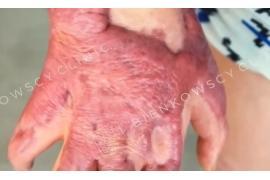 <b>GM. CZERSK. Alan z Rytla i efekty laseroterapii na przestrzeni kilku lat (WIDEO)</b>